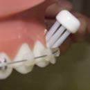 ブラケットの上側